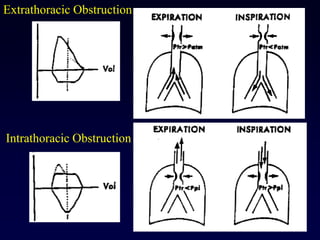Intrathoracic Obstruction
Extrathoracic Obstruction
 