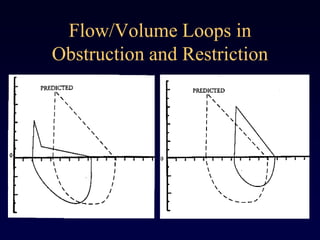 Flow/Volume Loops in
Obstruction and Restriction
 