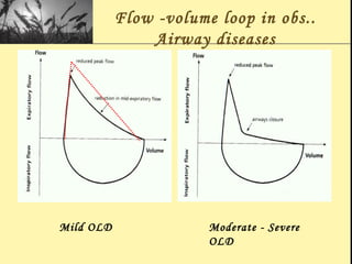 Flow -volume loop in obs..
Airway diseases
Mild OLD Moderate - Severe
OLD
 