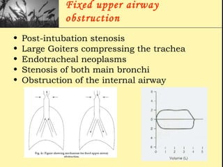 Fixed upper airway
obstruction
• Post-intubation stenosis
• Large Goiters compressing the trachea
• Endotracheal neoplasms
• Stenosis of both main bronchi
• Obstruction of the internal airway
 