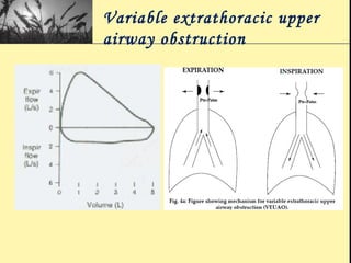 Variable extrathoracic upper
airway obstruction
 