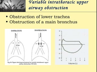Variable intrathoracic upper
airway obstruction
• Obstruction of lower trachea
• Obstruction of a main bronchus
 