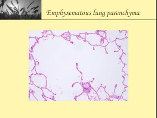 Emphysematous lung parenchyma
 