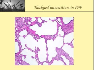 Thickned interstitium in IPF
 