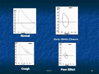 PFT IPFT I 7979
Early Glottic Closure
Normal
Poor EffortCough
 