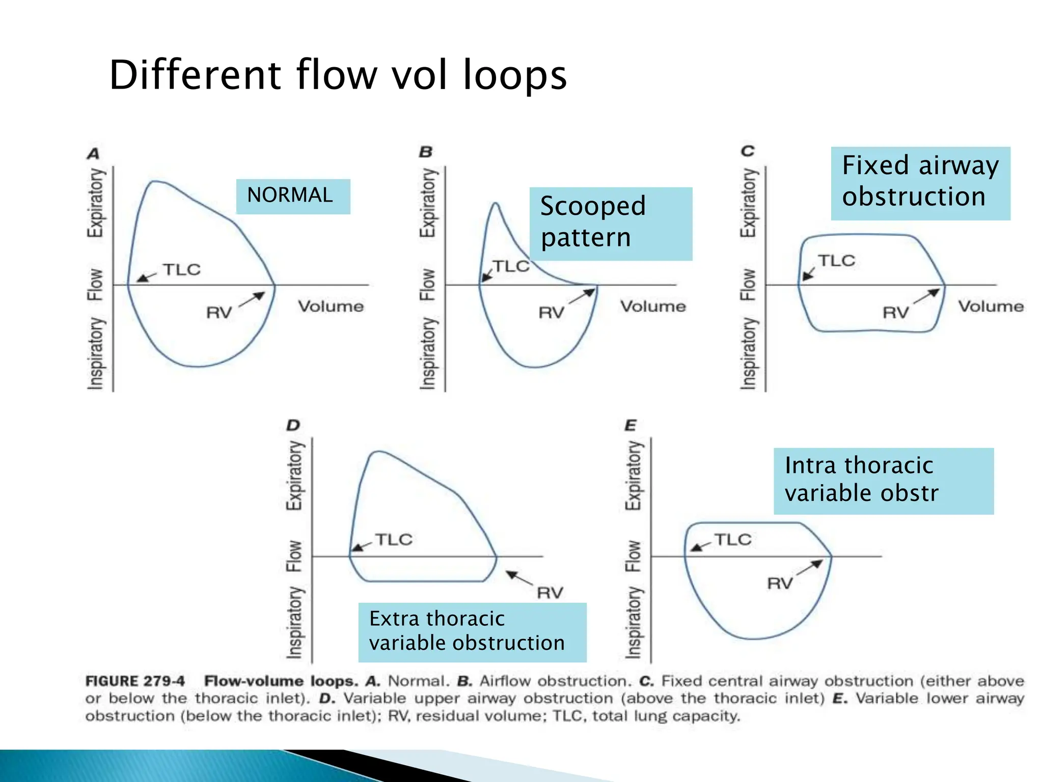 Different flow vol loops
NORMAL
Scooped
pattern
Fixed airway
obstruction
Extra thoracic
variable obstruction
Intra thoracic
variable obstr
 