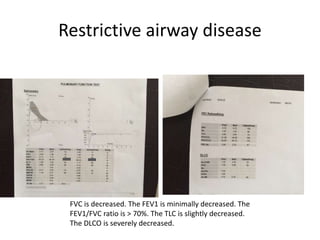 Restrictive airway disease
FVC is decreased. The FEV1 is minimally decreased. The
FEV1/FVC ratio is > 70%. The TLC is slightly decreased.
The DLCO is severely decreased.
 