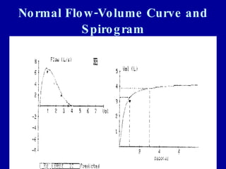 Normal Flow-Volume Curve and Spirogram 