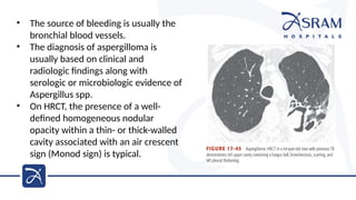 Manod Sign Pulmonary fungal infections.pptx lung dixeXe | PPTX