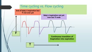 Time cycling vs. Flow cycling
T
F
Continuous transition of
Inspiration into expiration
End of baby’s inspiration but
Ti not over yet
Baby’s inspiration not yet
over but Ti ends
 