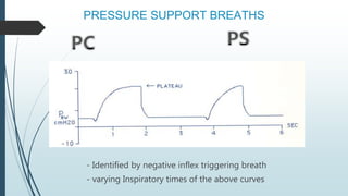 PRESSURE SUPPORT BREATHS
- Identified by negative inflex triggering breath
- varying Inspiratory times of the above curves
 