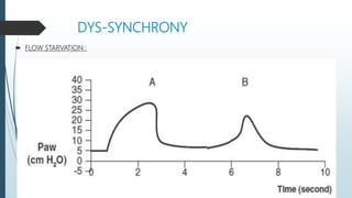 DYS‐SYNCHRONY
 FLOW STARVATION :
 