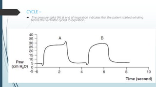 CYCLE –
 The pressure spike (A) at end of inspiration indicates that the patient started exhaling
before the ventilator cycled to expiration.
 