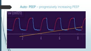 Auto‐ PEEP – progressively increasing PEEP
 