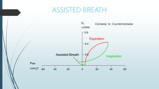 ASSISTED BREATH
Inspiration
Expiration
0 20 40 60
20
40
-60
0.2
LITERS
0.4
0.6
Paw
cmH2O
Assisted Breath
VT Clockwise to Counterclockwise
 