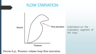 FLOW STARVATION
Indentation on the
inspiratory segment of
the loop
 