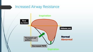 Increased Airway Resistance
Inspiration
Expiration
Volume (ml)
Flow
(L/min)
Decreased PEFR
Normal
Abnormal
“Scooped out”
pattern
 