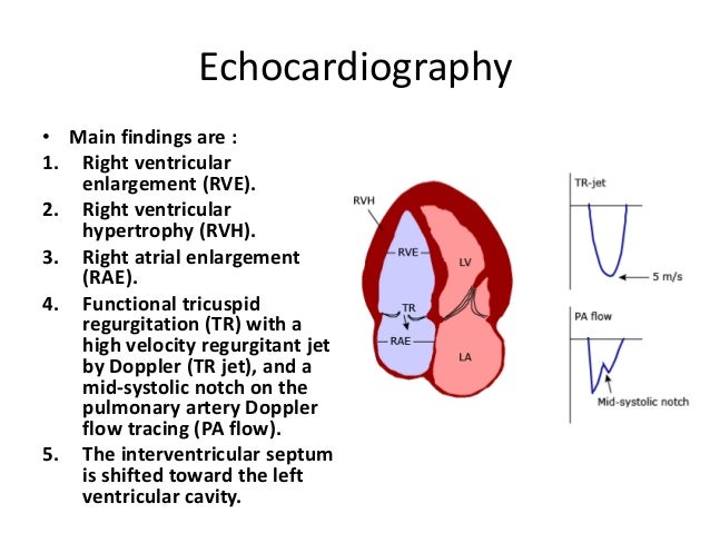 Echo Findings In Kawasaki Disease Echo Findings In Kawasaki Disease