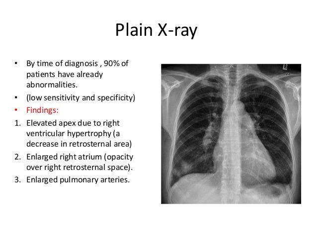 Enlarged Left Atrium Ct Carfareme 2019 2020