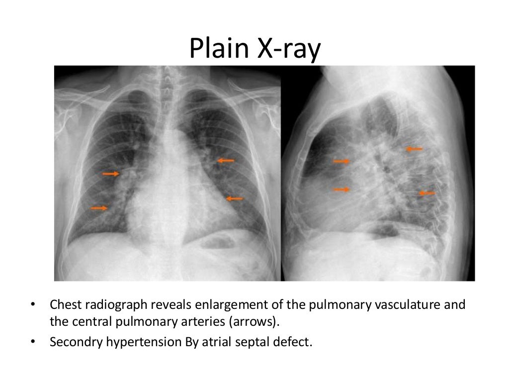 Radiology of Pulmonary Hypertension