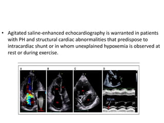 • Agitated saline-enhanced echocardiography is warranted in patients
with PH and structural cardiac abnormalities that predispose to
intracardiac shunt or in whom unexplained hypoxemia is observed at
rest or during exercise.
 