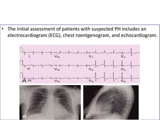 • The initial assessment of patients with suspected PH includes an
electrocardiogram (ECG), chest roentgenogram, and echocardiogram.
 