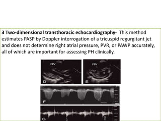 3 Two-dimensional transthoracic echocardiography- This method
estimates PASP by Doppler interrogation of a tricuspid regurgitant jet
and does not determine right atrial pressure, PVR, or PAWP accurately,
all of which are important for assessing PH clinically.
 