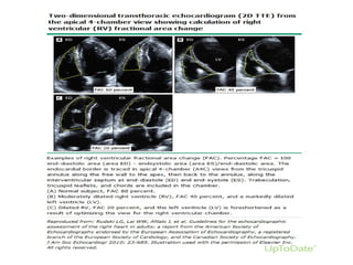 echocardiographic evaluation of right heart | PPTX