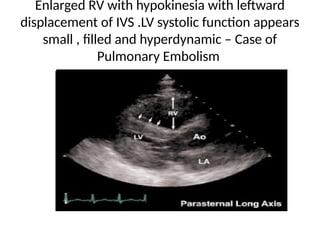 echocardiographic evaluation of right heart | PPTX