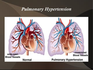 Pulmonary Hypertension
 