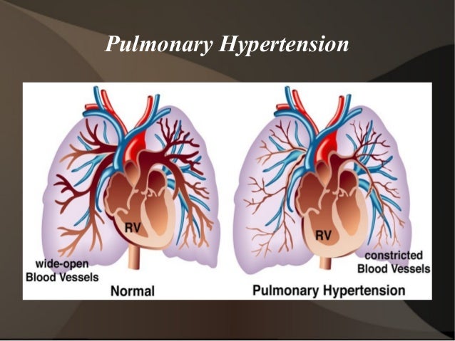 5 Types Of Pulmonary Hypertension Vrogue co pulmonary-hypertension-pictures
