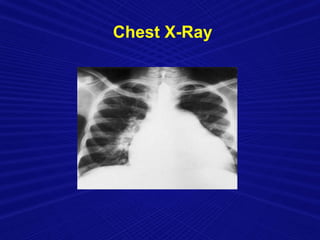 Chest X-Ray
 