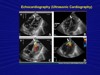 Echocardiography (Ultrasonic Cardiography)
 