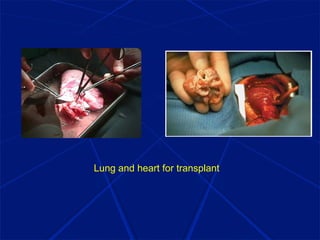Lung and heart for transplant
 