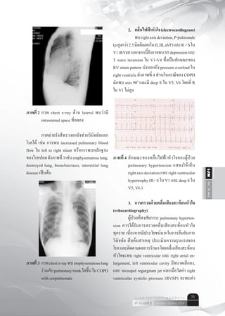 Vol.10No.2IJM
เมษายน - มิถุนายน 2554ปีที่ 10 ฉบับที่ 2
ว า ร ส า ร อ า ยุ ร ศ า ส ต ร์ อี ส า น 11
ภาพที่ 2	ภาพ chest x-ray ด้าน lateral พบว่ามี
	 retrosternal space ที่ลดลง
	 ภาพถ่ายรังสีทรวงอกยังช่วยวินิจฉัยแยก
โรคได้ เช่น การพบ increased pulmonary blood
flow ใน left to right shunt หรือการพบหลักฐาน
ของโรคปอดดังภาพที่3เช่นemphysematouslung,
destroyed lung, bronchiectasis, interstitial lung
disease เป็นต้น
ภาพที่ 3	ภาพchestx-rayพบemphysematouslung
	 ร่วมกับpulmonarytrunkโตขึ้นในCOPD
	 with corpulmonale
	 2.	 คลื่นไฟฟ้าหัวใจ(electrocardiogram)
	 	 พบrightaxisdeviation,P-pulmonale
(pสูงกว่า2.5มิลลิเมตรในII,III,aVF)และR>Sใน
V1(RVH)นอกจากนี้ยังอาจพบSTdepressionและ
T wave inversion ใน V1-V4 ซึ่งเป็นลักษณะของ
RV strain pattern บ่งบอกถึง pressure overload ใน
right ventricle ดังภาพที่ 4 ส่วนในกรณีของ COPD
มักพบ axis 90o
และมี deep S ใน V5, V6 โดยที่ R
ใน V1 ไม่สูง
ภาพที่ 4	ลักษณะของคลื่นไฟฟ้าหัวใจของผู้ป่วย
	 pulmonary hypertension แสดงให้เห็น
	 rightaxisdeviationและrightventricular
	 hypertrophy(R>SในV1และdeepSใน
	 V5, V6 )
	 3.	 การตรวจด้วยคลื่นเสียงสะท้อนหัวใจ
(echocardiography)
	 ผู้ป่วยที่สงสัยภาวะ pulmonary hyperten-
sion ควรได้รับการตรวจคลื่นเสียงสะท้อนหัวใจ
ทุกราย เนื่องจากมีประโยชน์มากในการยืนยันการ
วินิจฉัย สืบค้นสาเหตุ ประเมินความรุนแรงของ
โรคและติดตามผลการรักษาโดยคลื่นเสียงสะท้อน
หัวใจจะพบ right ventricular และ right atrial en-
largement, left ventricular cavity มีขนาดเล็กลง,
และ tricuspid regurgitant jet และเมื่อวัดค่า right
ventricular systolic pressure (RVSP) จะพบค่า
3
ภาพที่ 1 ภาพ chest x-ray ดาน PA พบวามี pulmonary trunk โตขึ้น
ภาพที่ 2 ภาพ chest x-ray ดาน lateral พบวามี retrosternal space ที่ลดลง
ภาพถายรังสีทรวงอกยังชวยวินิจฉัยแยกโรคได เชน การพบ increased pulmonary
blood flow ใน left to right shunt หรือการพบหลักฐานของโรคปอด ดังภาพที่ 3 เชน
emphysematous lung, destroyed lung, bronchiectasis, interstitial lung disease เปนตน
ภาพที่ 3 ภาพ chest x-ray พบ emphysematous lung รวมกับ pulmonary trunk โตขึ้น
ใน COPD with corpulmonale
2. คลื่นไฟฟาหัวใจ (electrocardiogram)
พบ right axis deviation, P-pulmonale (p สูงกวา 2.5 มิลลิเมตรใน II, III, aVF) และ R
> S ใน V1 (RVH) นอกจากนี้ยังอาจพบ ST depression และ T wave inversion ใน V1-V4 ซึ่ง
เปนลักษณะของ RV strain pattern บงบอกถึง pressure overload ใน right ventricle ดังภาพ
4
ภาพที่ 3 ภาพ chest x-ray พบ emphysematous lung รวมกับ pulmonary trunk โตขึ้น
ใน COPD with corpulmonale
2. คลื่นไฟฟาหัวใจ (electrocardiogram)
พบ right axis deviation, P-pulmonale (p สูงกวา 2.5 มิลลิเมตรใน II, III, aVF) และ R
> S ใน V1 (RVH) นอกจากนี้ยังอาจพบ ST depression และ T wave inversion ใน V1-V4 ซึ่ง
เปนลักษณะของ RV strain pattern บงบอกถึง pressure overload ใน right ventricle ดังภาพ
ที่ 4 สวนในกรณีของ COPD มักพบ axis 90o
และมี deep S ใน V5, V6 โดยที่ R ใน V1 ไมสูง
ภาพที่ 4 ลักษณะของคลื่นไฟฟาหัวใจของผูปวย pulmonary hypertension แสดงใหเห็น right
axis deviation และ right ventricular hypertrophy (R> S ใน V1 และ deep S ใน V5, V6 )
 