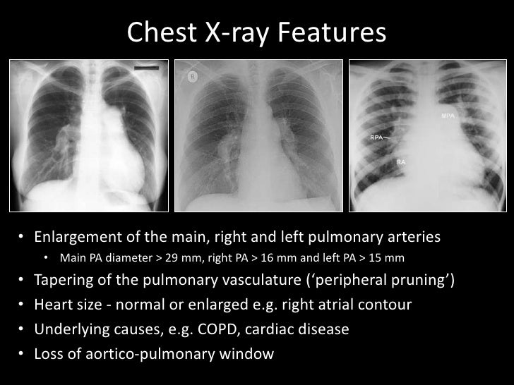 Pulmonary hypertension and the Intensivist