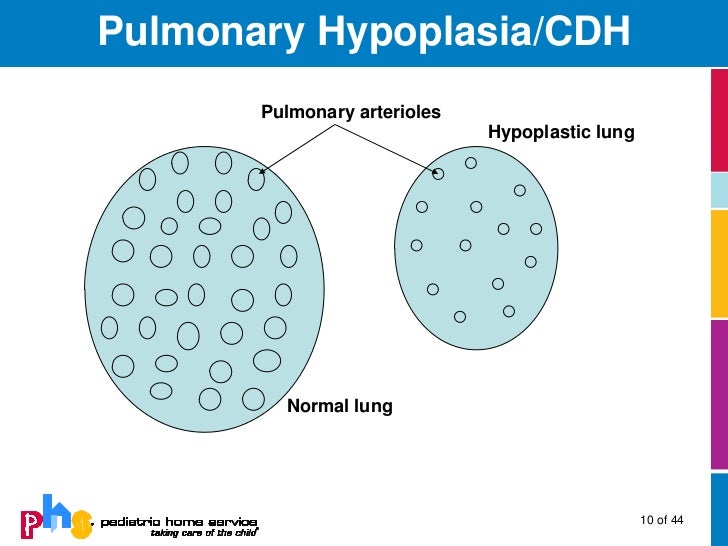 Pulmonary Hypertensionvin Infants and Children