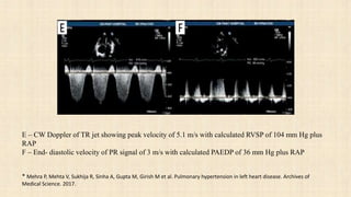 Tr Jet Rvsp Pulmonary hypertention in left heart diseases PH-LHD | PPTX