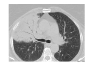 Diagnostic Imaging of Pulmonary infections | PPT