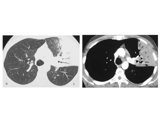 Diagnostic Imaging of Pulmonary infections | PPT