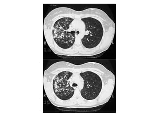 Diagnostic Imaging of Pulmonary infections | PPT
