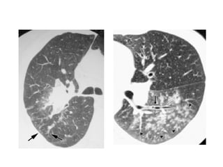 Diagnostic Imaging of Pulmonary infections | PPT