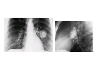 Diagnostic Imaging of Pulmonary infections | PPT