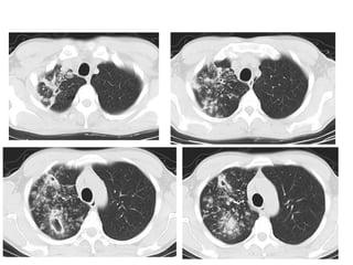 Diagnostic Imaging of Pulmonary infections | PPT