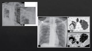 ROLE OF RADIOLOGY IN PULMONARY INFECTIONS | PPTX