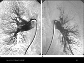PUL.INTERVENTIONAL RADIOLOGY 34
 