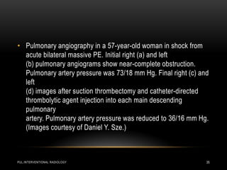 PUL.INTERVENTIONAL RADIOLOGY 35
• Pulmonary angiography in a 57-year-old woman in shock from
acute bilateral massive PE. Initial right (a) and left
(b) pulmonary angiograms show near-complete obstruction.
Pulmonary artery pressure was 73/18 mm Hg. Final right (c) and
left
(d) images after suction thrombectomy and catheter-directed
thrombolytic agent injection into each main descending
pulmonary
artery. Pulmonary artery pressure was reduced to 36/16 mm Hg.
(Images courtesy of Daniel Y. Sze.)
 