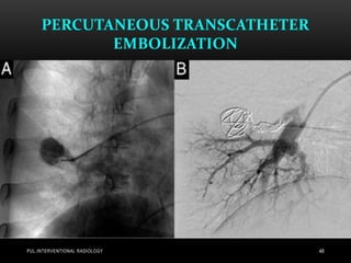 PERCUTANEOUS TRANSCATHETER
EMBOLIZATION
PUL.INTERVENTIONAL RADIOLOGY 48
 