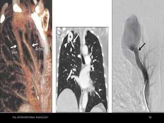 PUL.INTERVENTIONAL RADIOLOGY 50
 