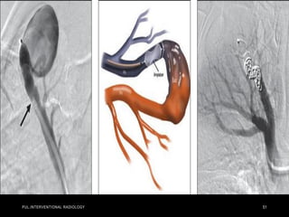 PUL.INTERVENTIONAL RADIOLOGY 51
 